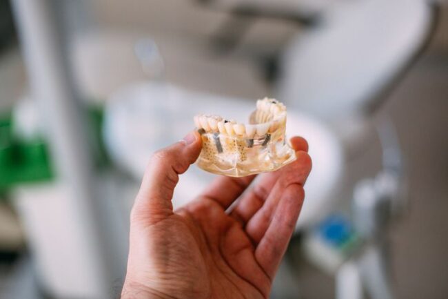 implantes dentales Palencia