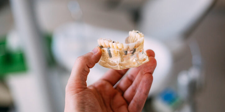 implantes dentales Palencia