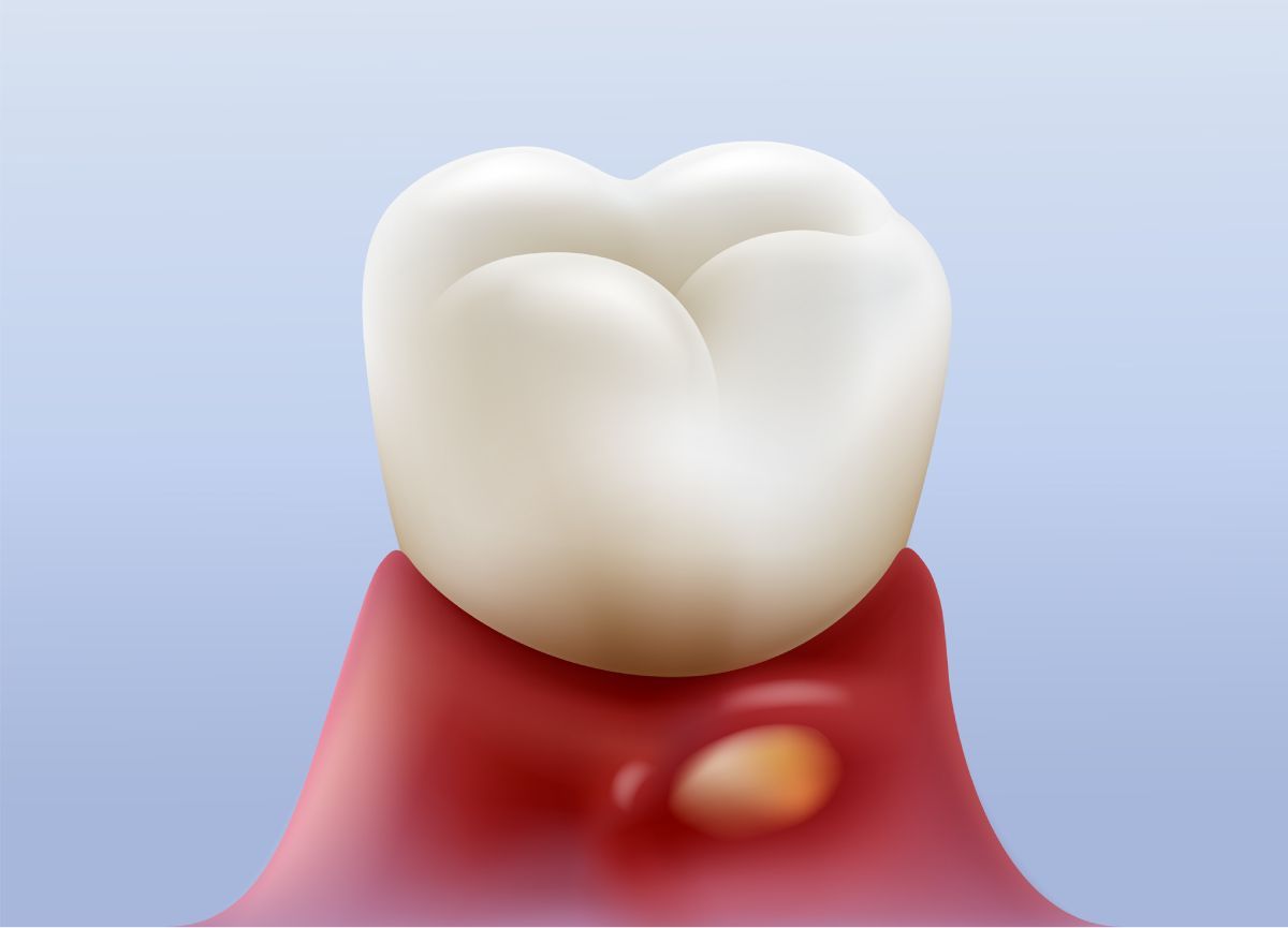 periodoncia